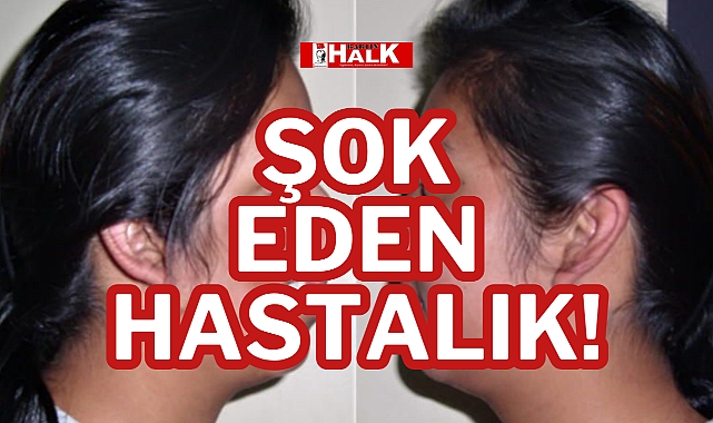 ŞOK EDEN HASTALIK!