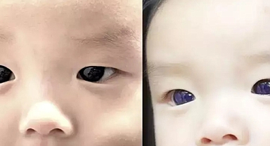 Covid tedavisi göz rengini değiştirdi!