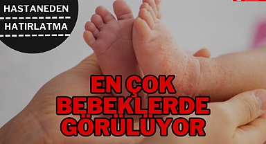EN ÇOK BEBEKLERDE GÖRÜLÜYOR