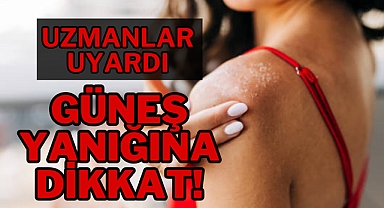 GÜNEŞ YANIĞINA DİKKAT!