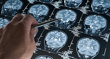 Alzheimer Bulaşıcı Mı?